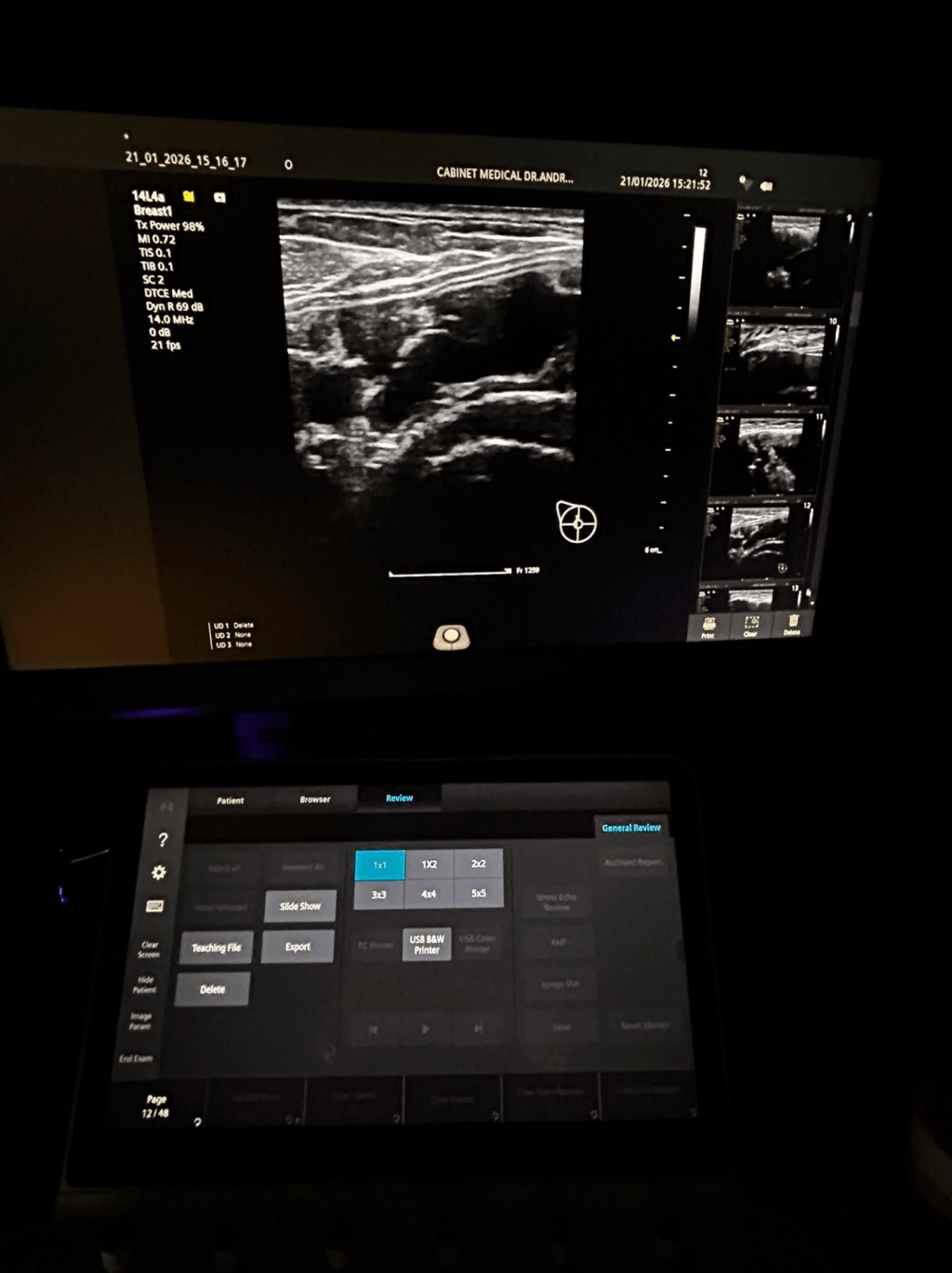 Ruptura intracapsularã a implantului&nbsp;mamar