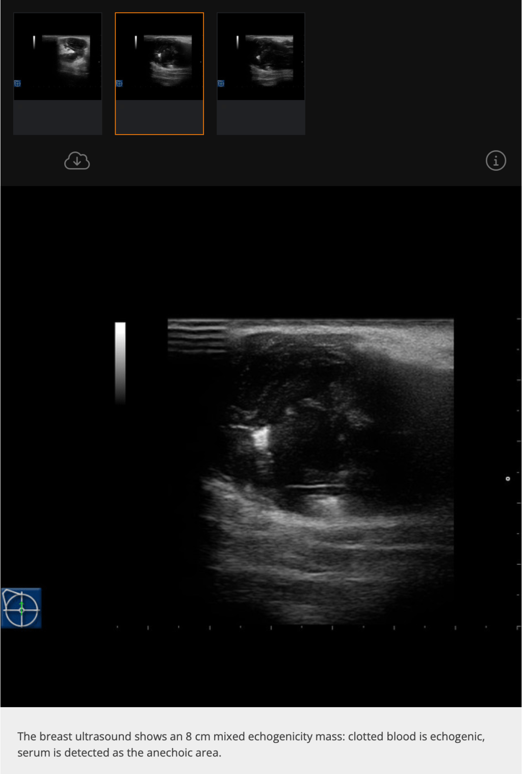 Exista hematom mamar?
